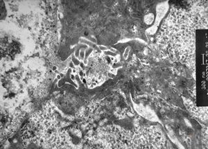 F,7m. | giant cell hepatitis F,7m. | giant cell hepatitis